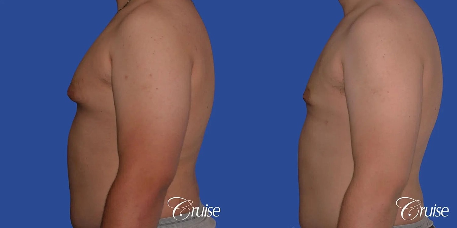 Gynecomastia Surgery Before & After