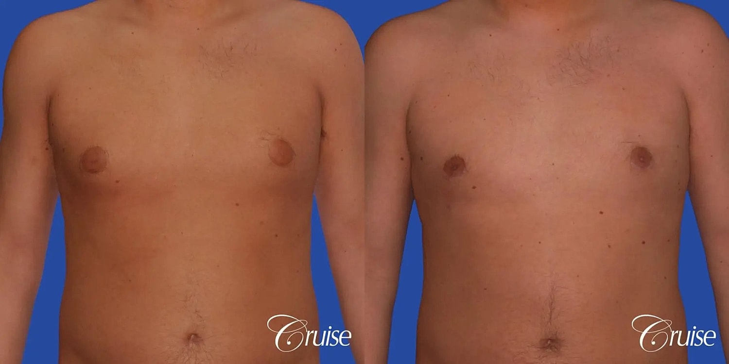 Gynecomastia Surgery Before & After