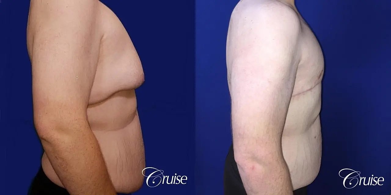 Gynecomastia Surgery Before & After