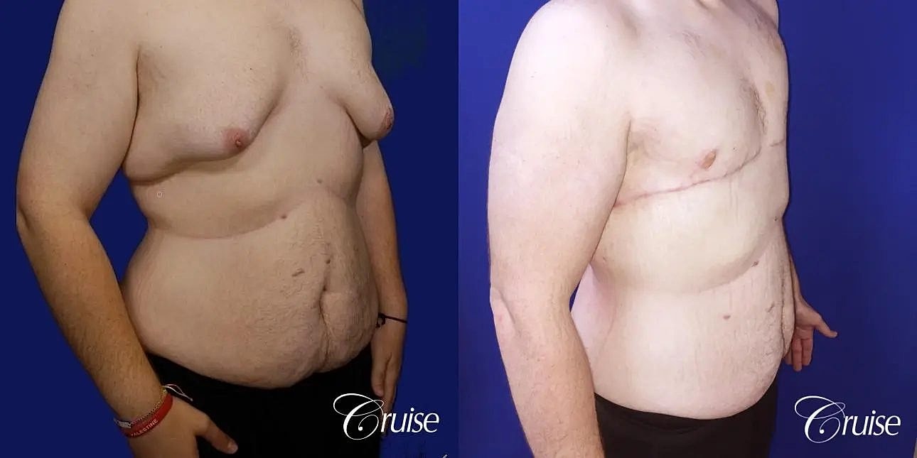 Gynecomastia Surgery Before & After