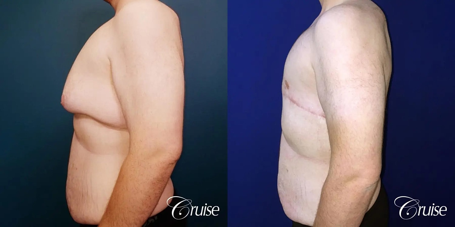 Gynecomastia Surgery Before & After