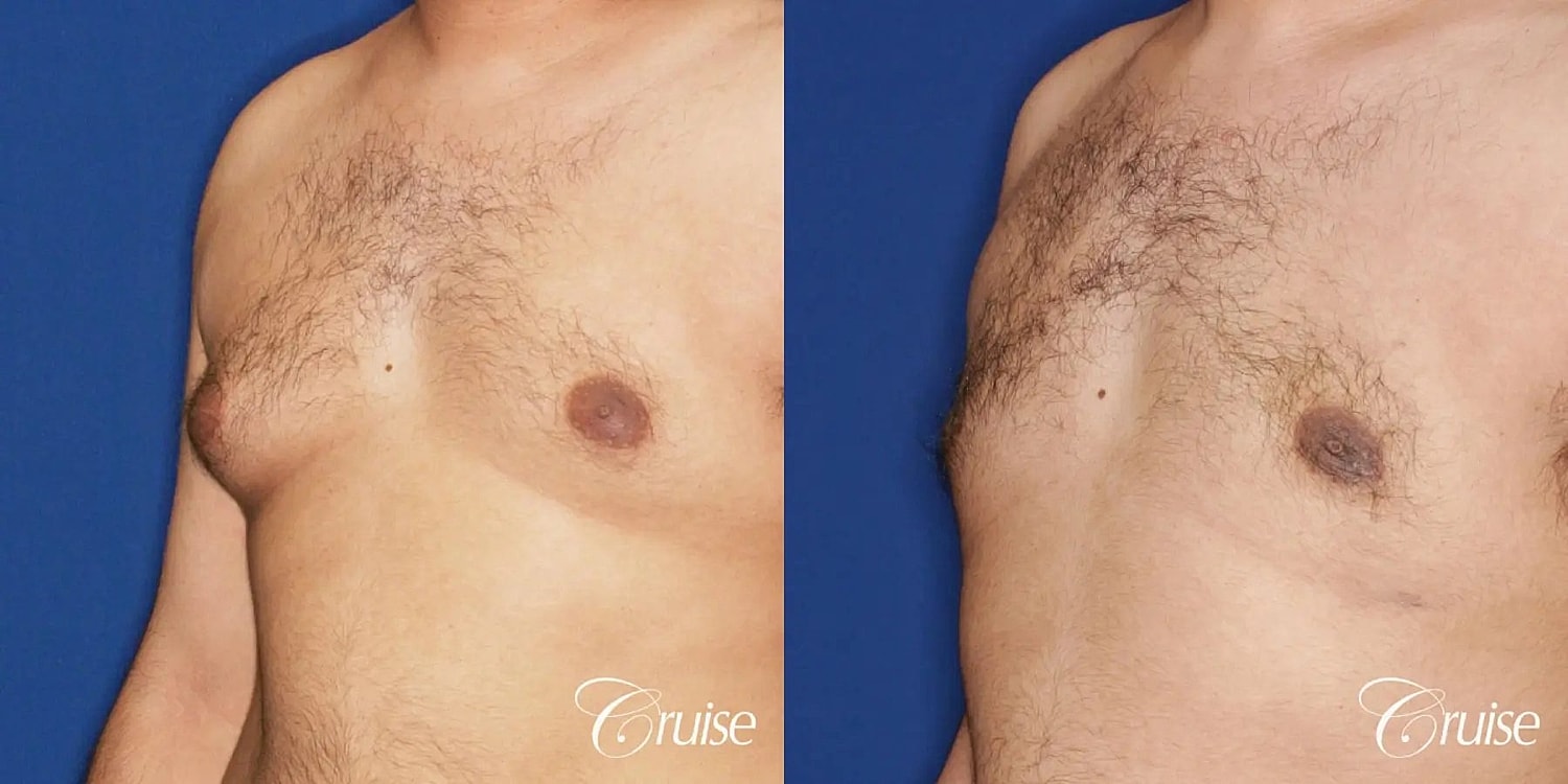 Gynecomastia Surgery Before & After
