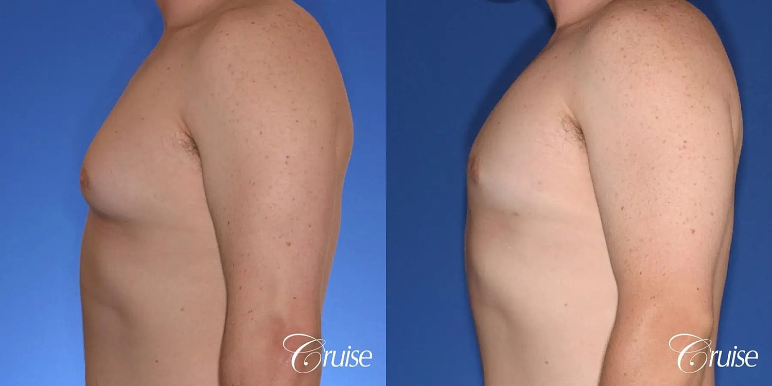 Gynecomastia Surgery Before & After
