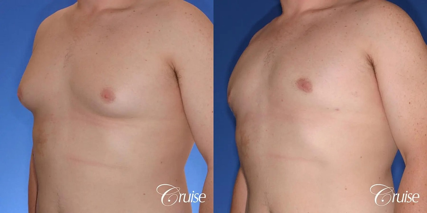 Gynecomastia Surgery Before & After