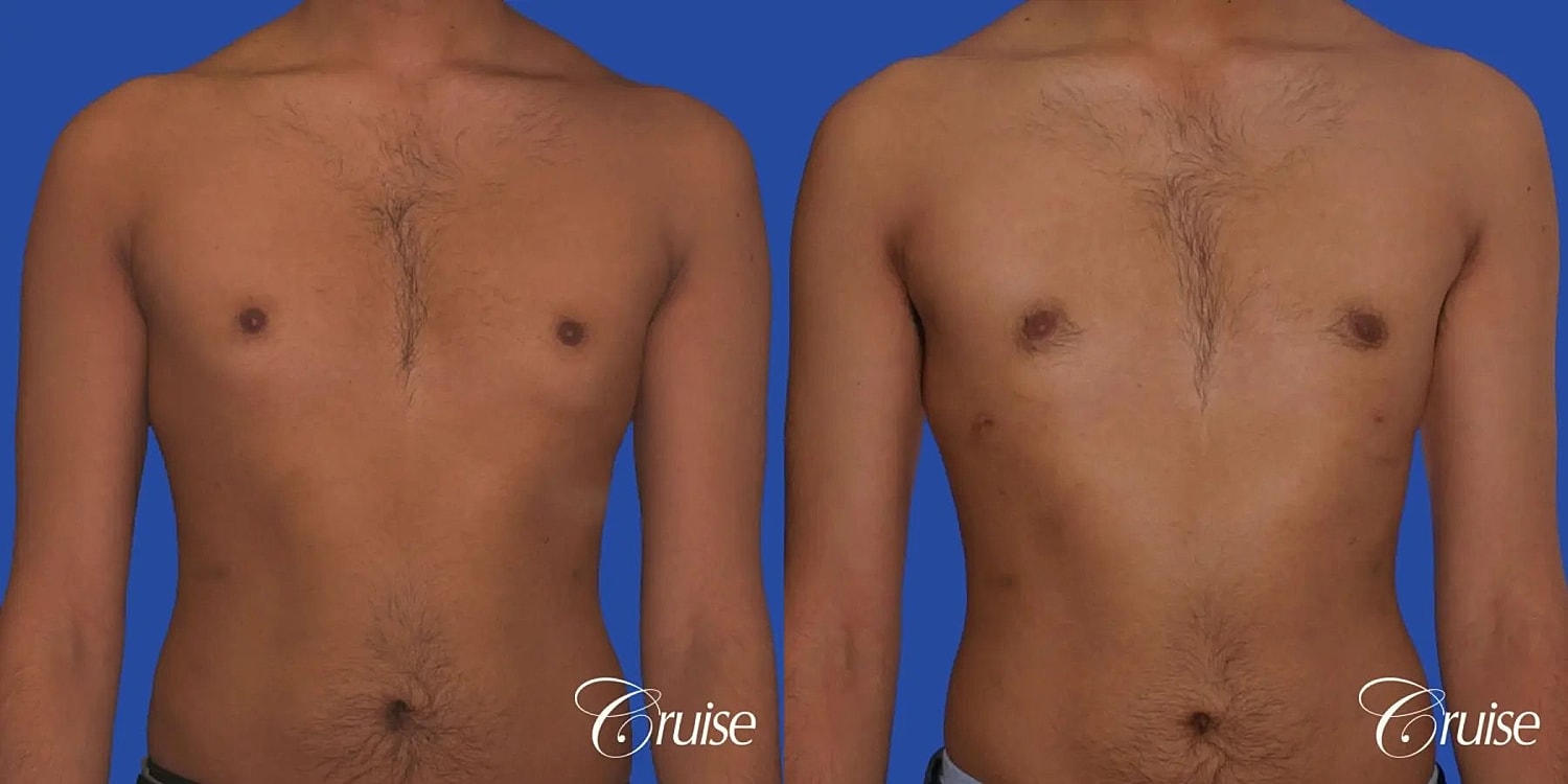 Gynecomastia Surgery Before & After