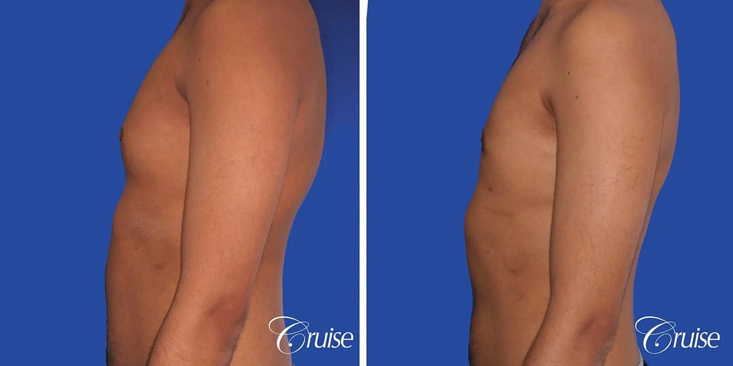 Gynecomastia Surgery Before & After