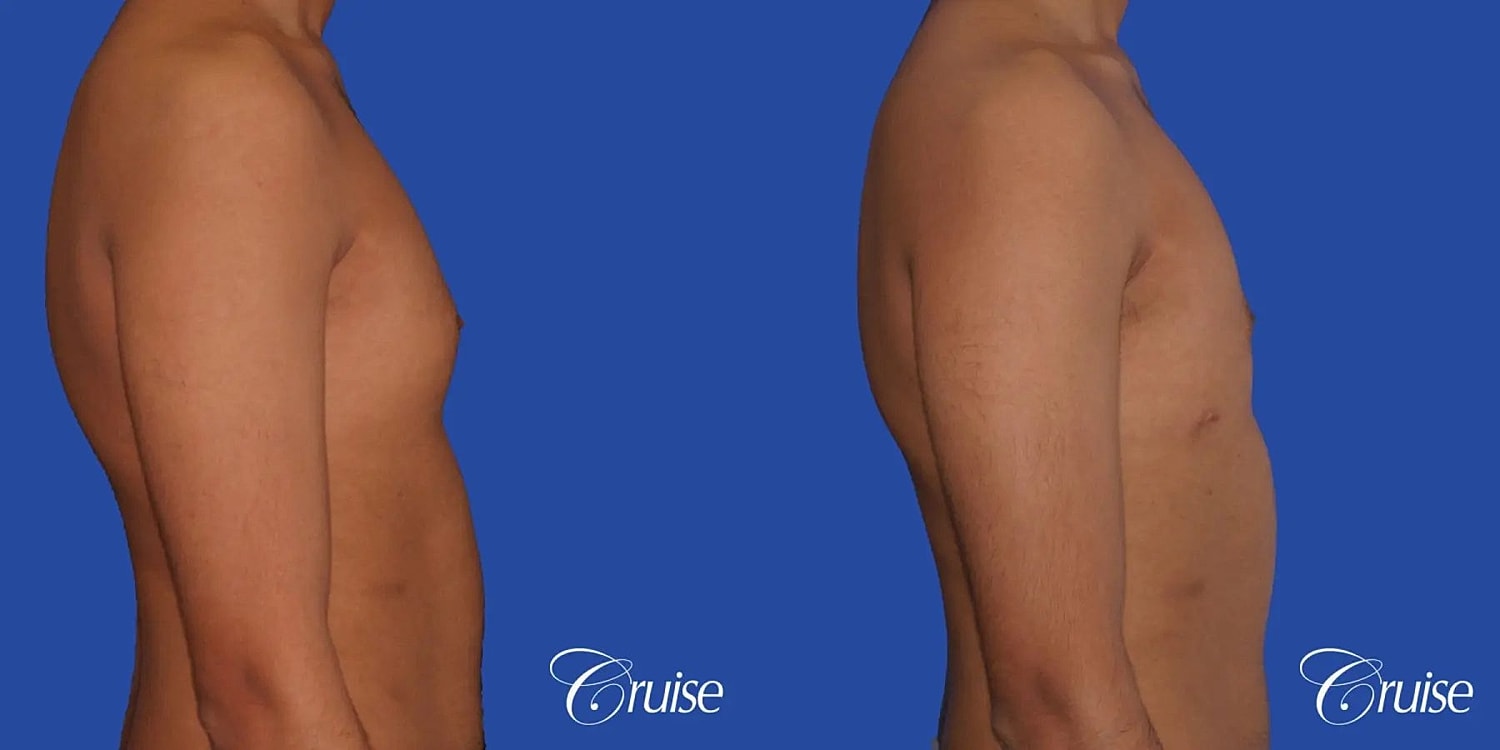 Gynecomastia Surgery Before & After