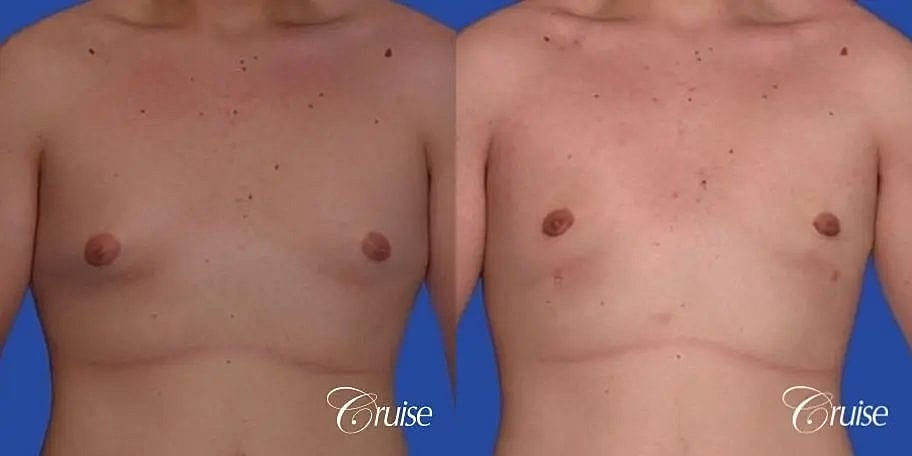 Gynecomastia Surgery Before & After