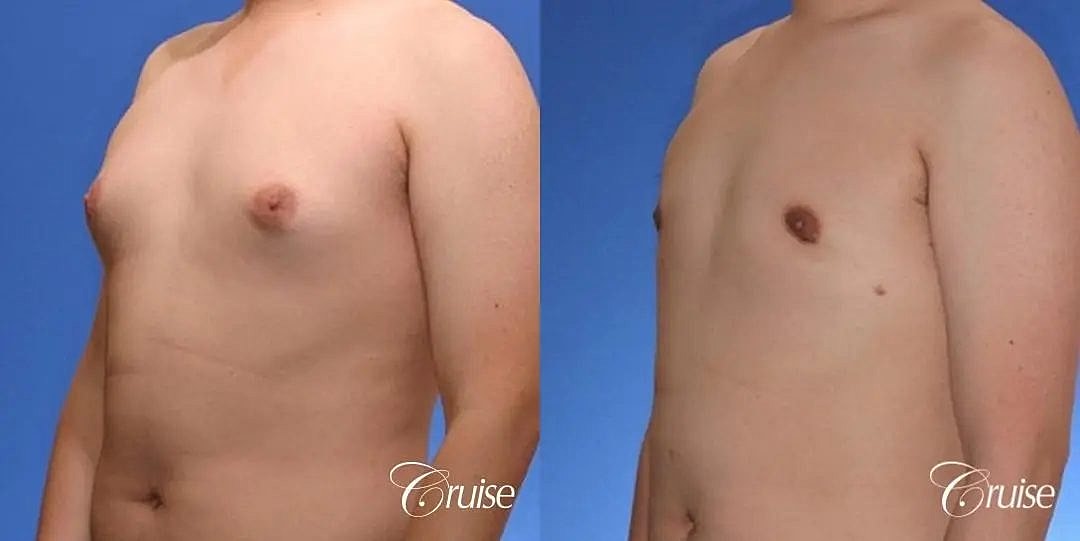 Gynecomastia Surgery Before & After