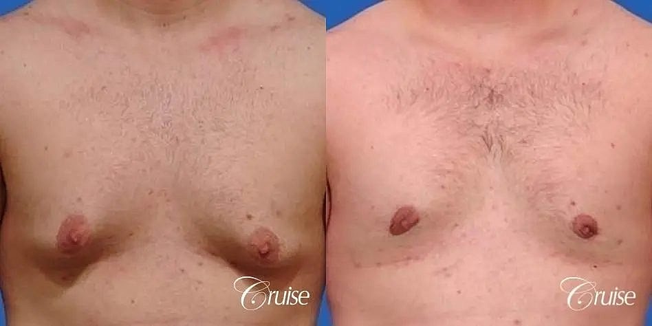 Gynecomastia Surgery Before & After