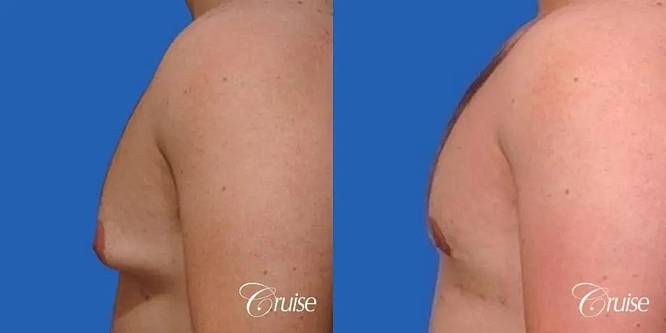 Gynecomastia Surgery Before & After