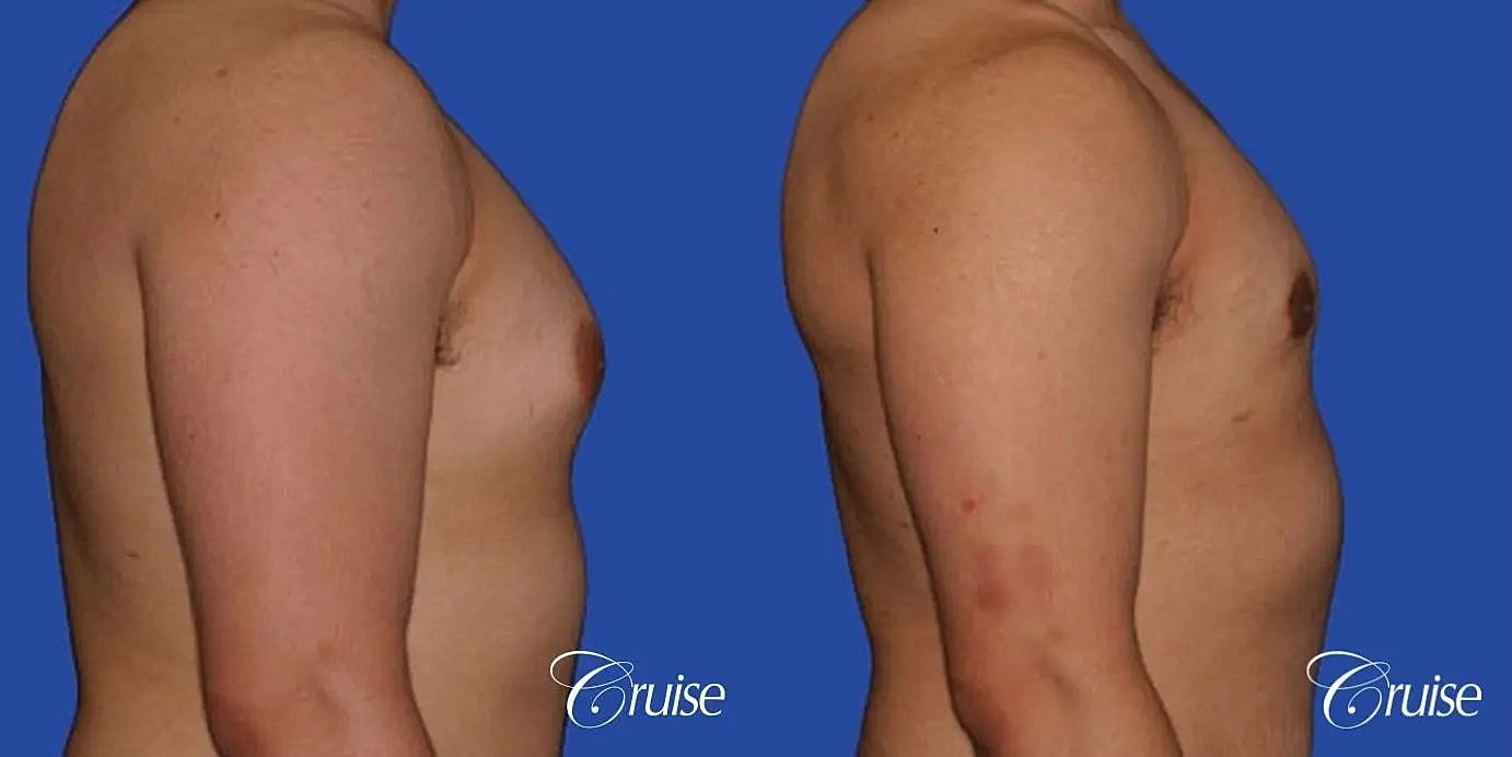 Gynecomastia Surgery Before & After