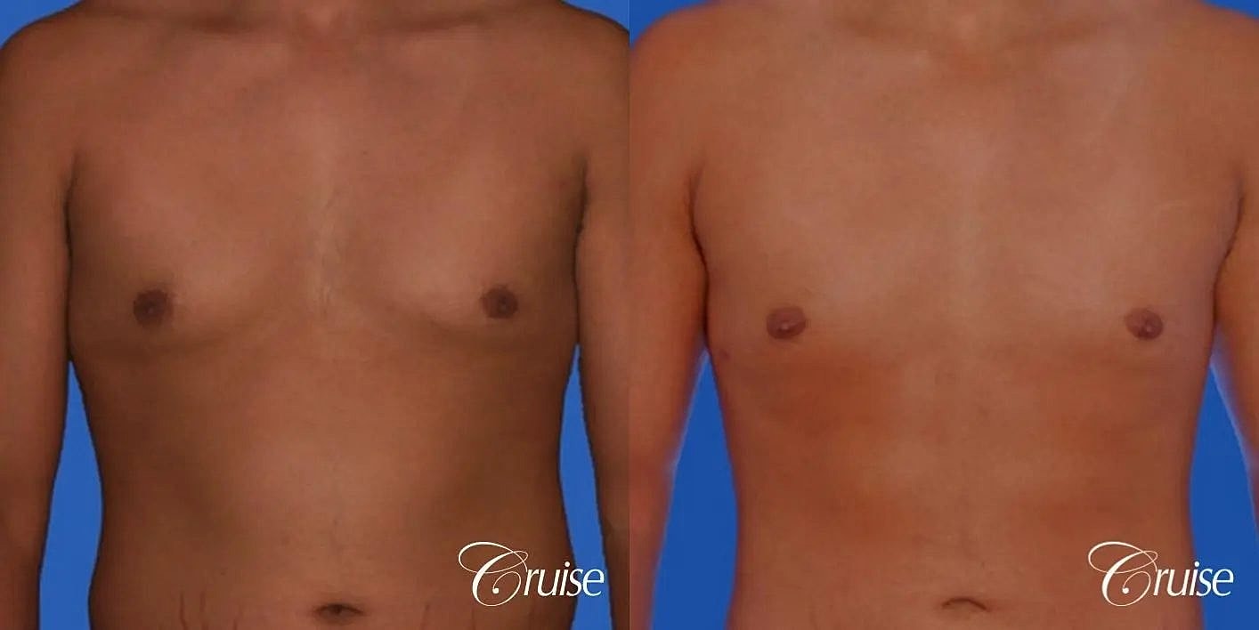 Gynecomastia Surgery Before & After