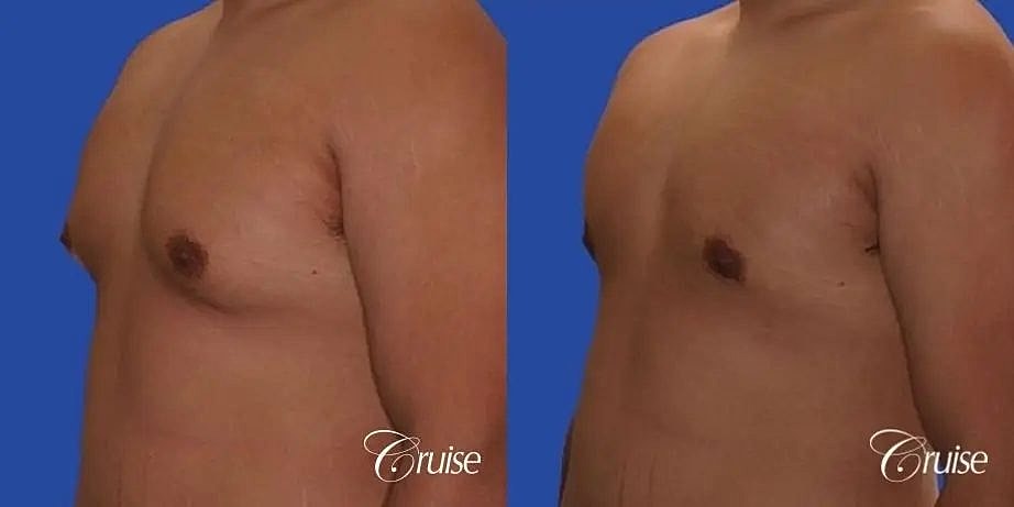 Gynecomastia Surgery Before & After