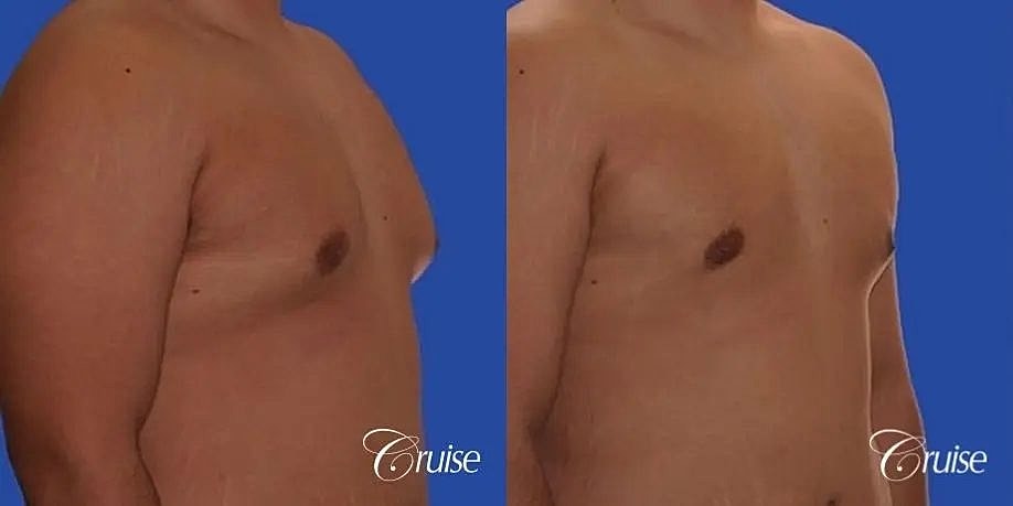 Gynecomastia Surgery Before & After