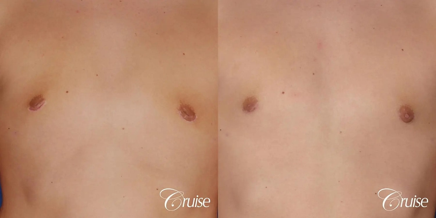 Gynecomastia Surgery Before & After