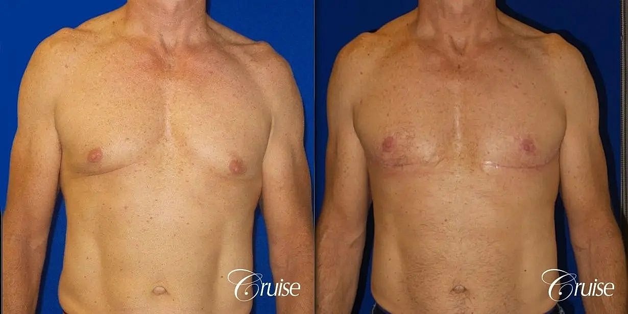 Gynecomastia Surgery Before & After