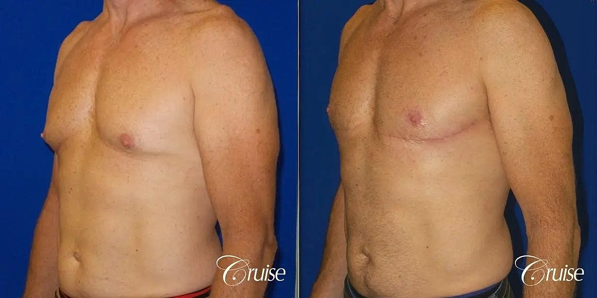 Gynecomastia Surgery Before & After