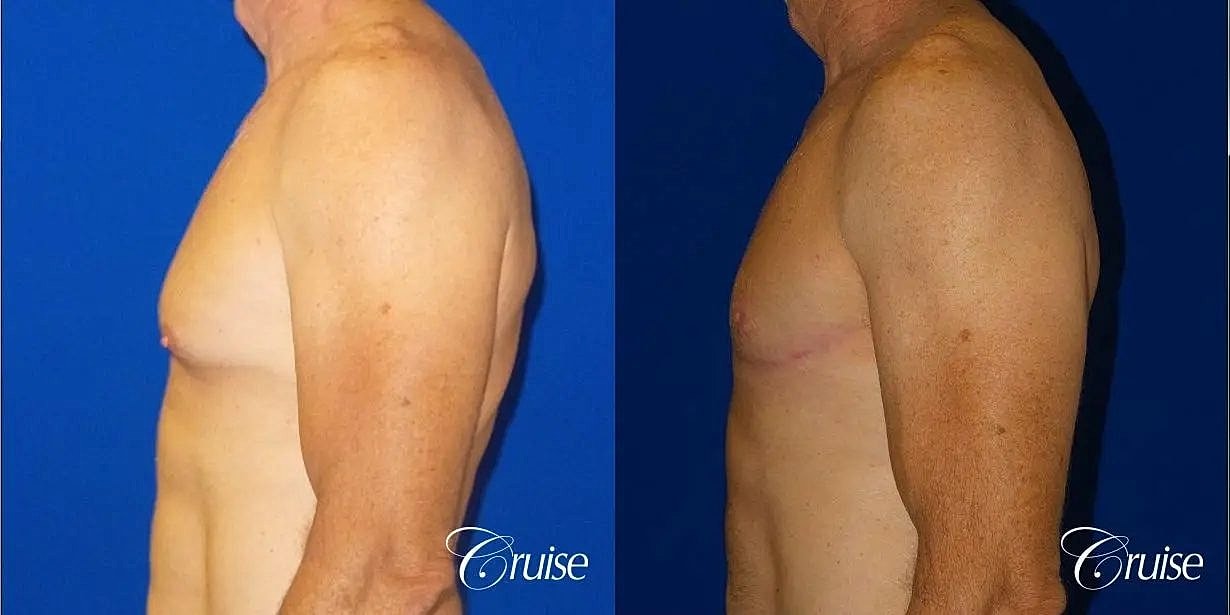 Gynecomastia Surgery Before & After