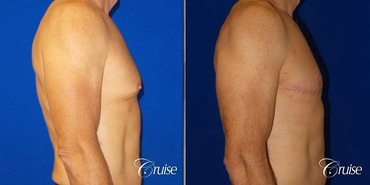 Gynecomastia Surgery Before & After