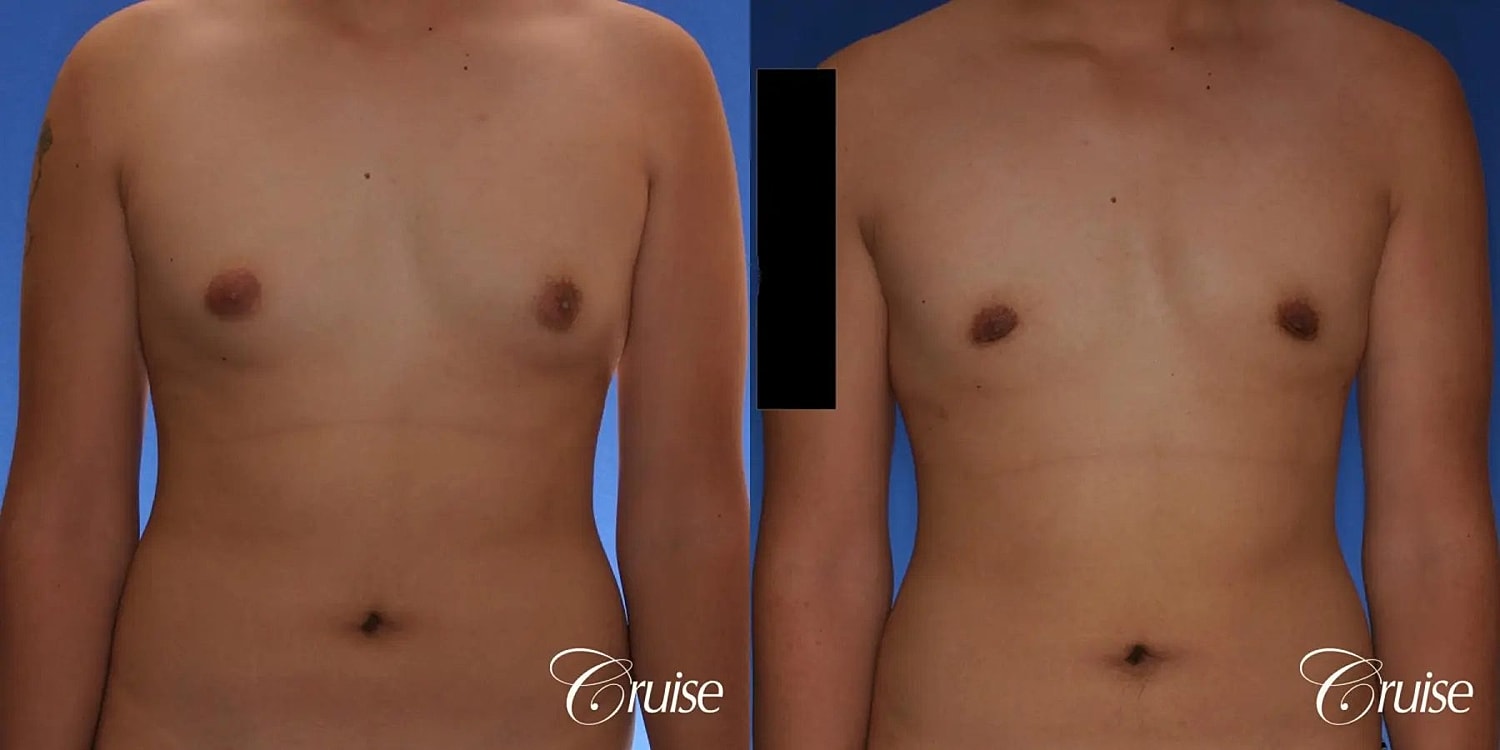 Gynecomastia Surgery Before & After