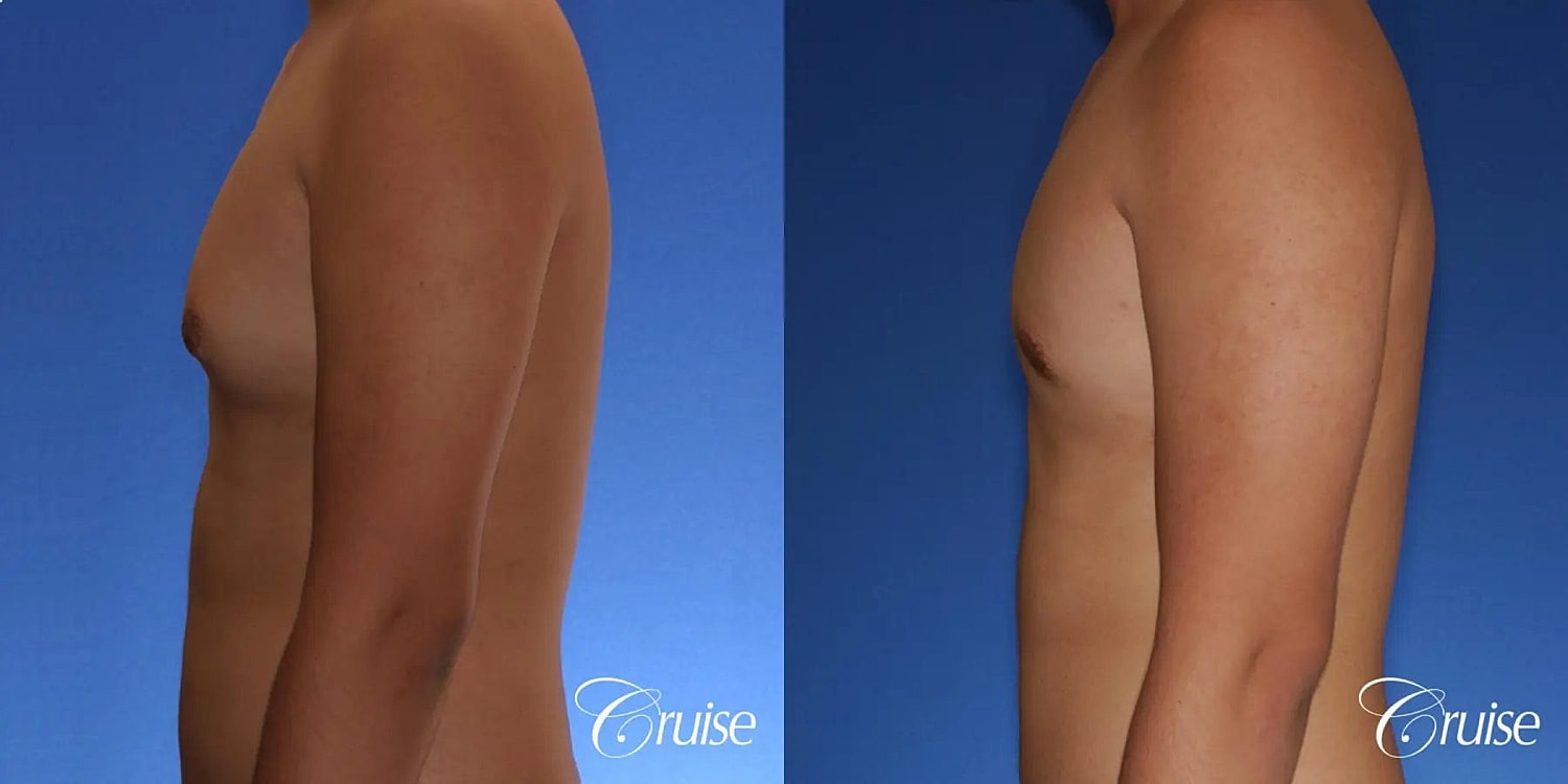 Gynecomastia Surgery Before & After