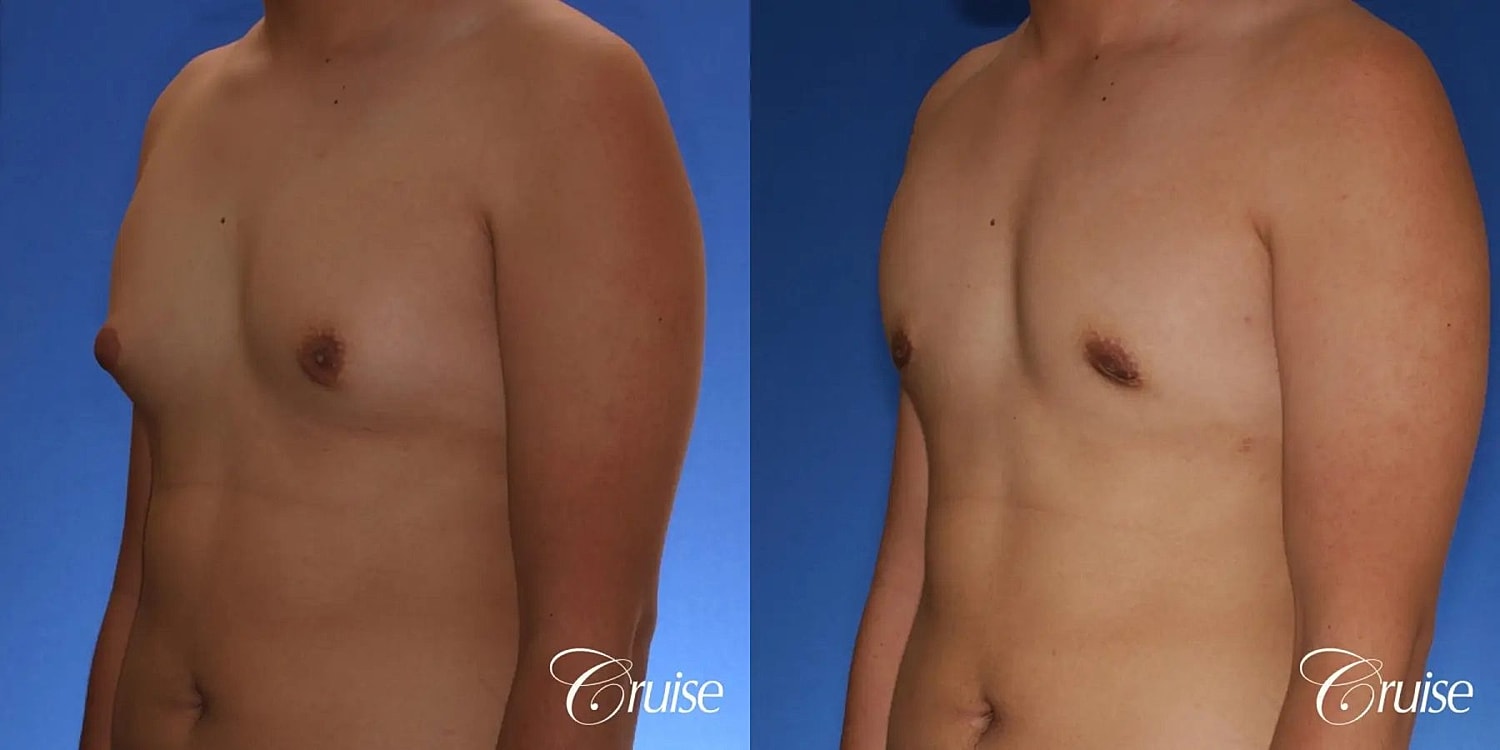 Gynecomastia Surgery Before & After