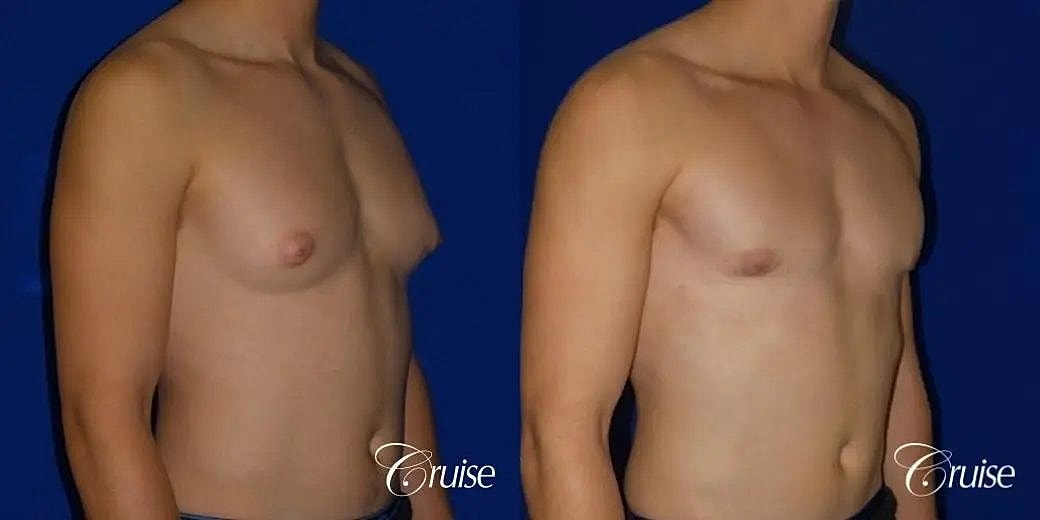 Gynecomastia Surgery Before & After