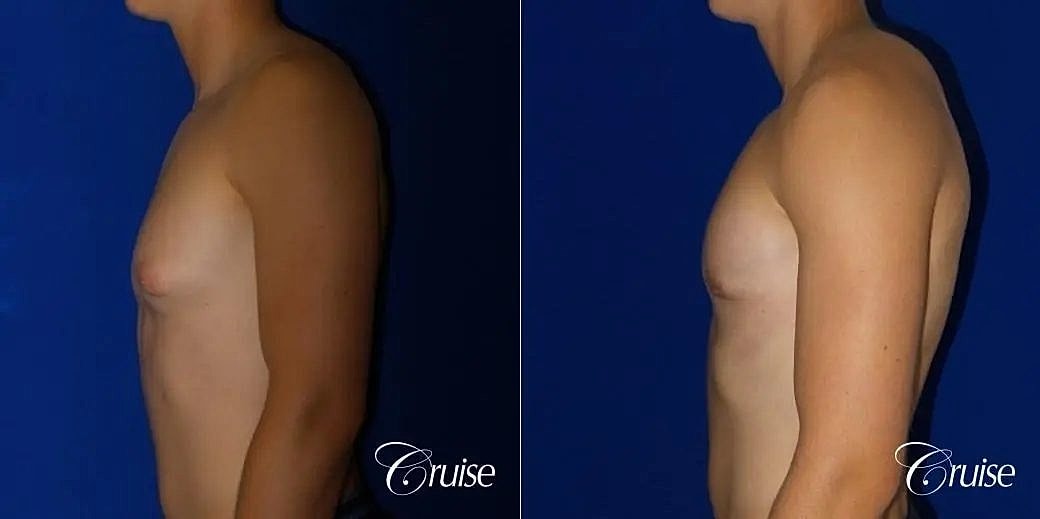 Gynecomastia Surgery Before & After