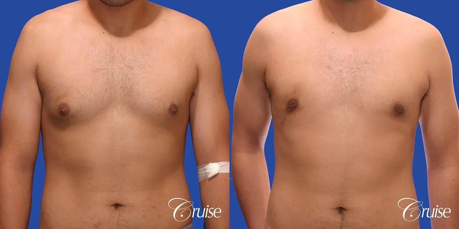 Gynecomastia Surgery Before & After