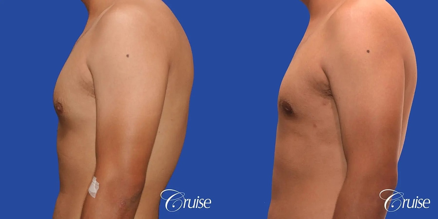Gynecomastia Surgery Before & After