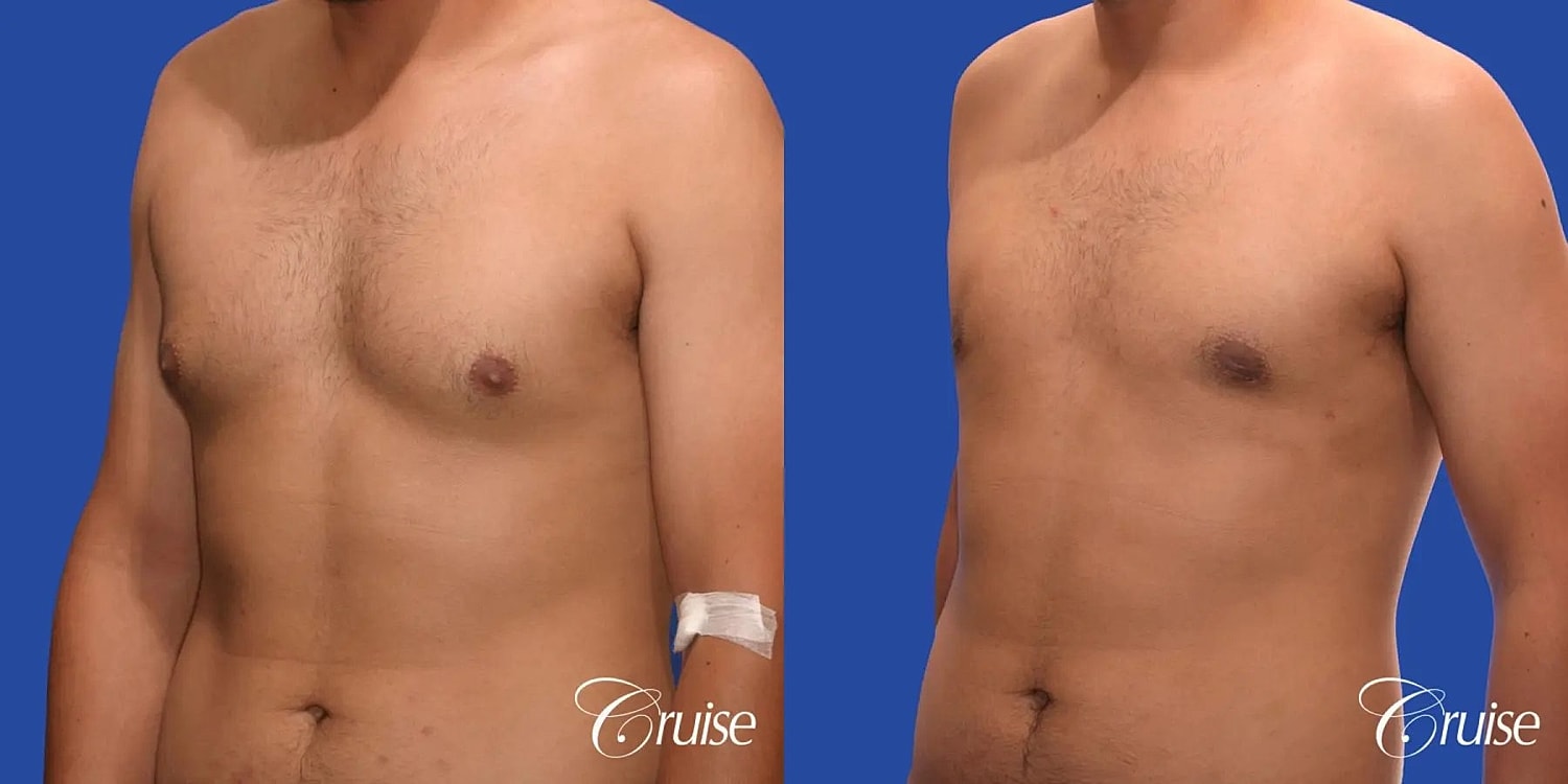 Gynecomastia Surgery Before & After