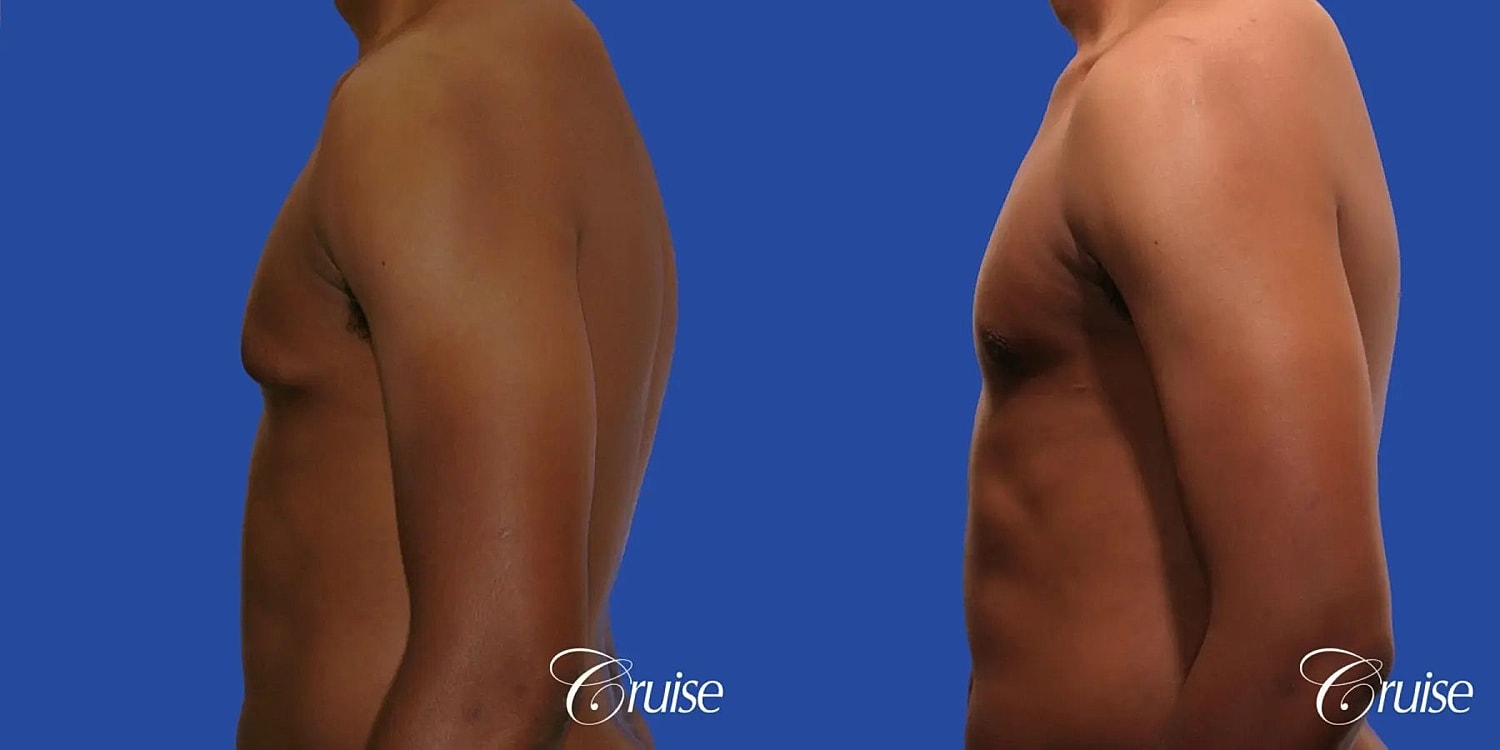 Gynecomastia Surgery Before & After