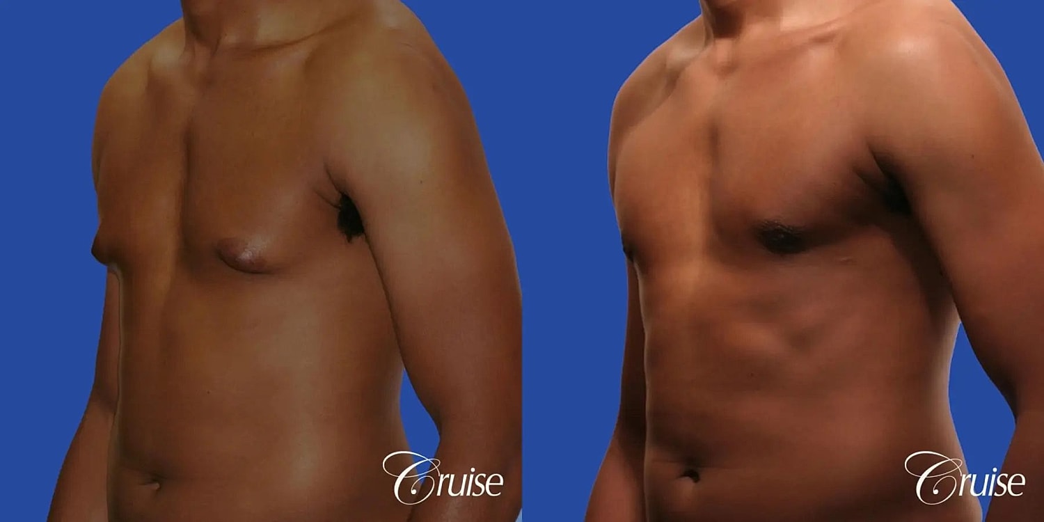 Gynecomastia Surgery Before & After