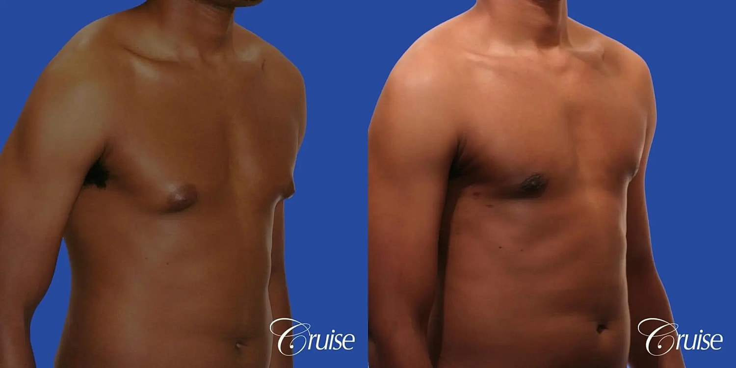 Gynecomastia Surgery Before & After