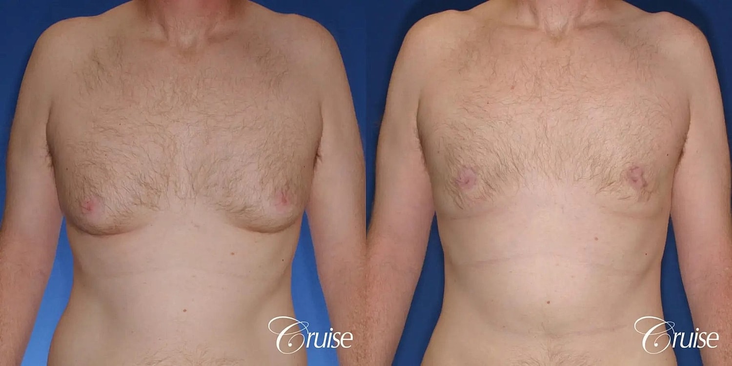 Gynecomastia Surgery Before & After