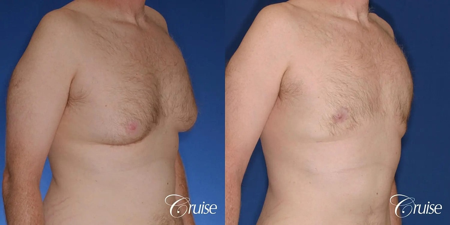 Gynecomastia Surgery Before & After