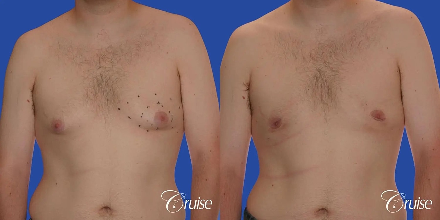 Gynecomastia Surgery Before & After