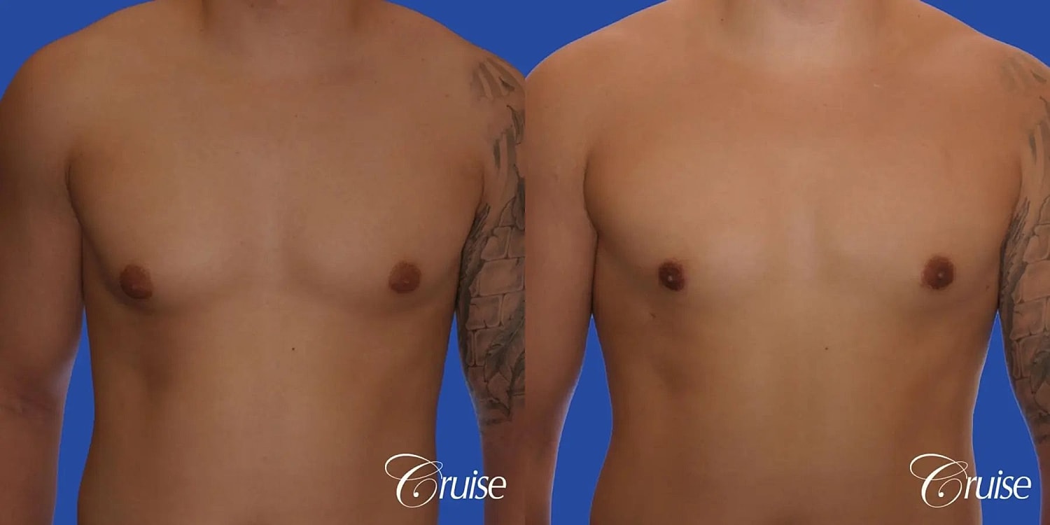 Gynecomastia Surgery Before & After