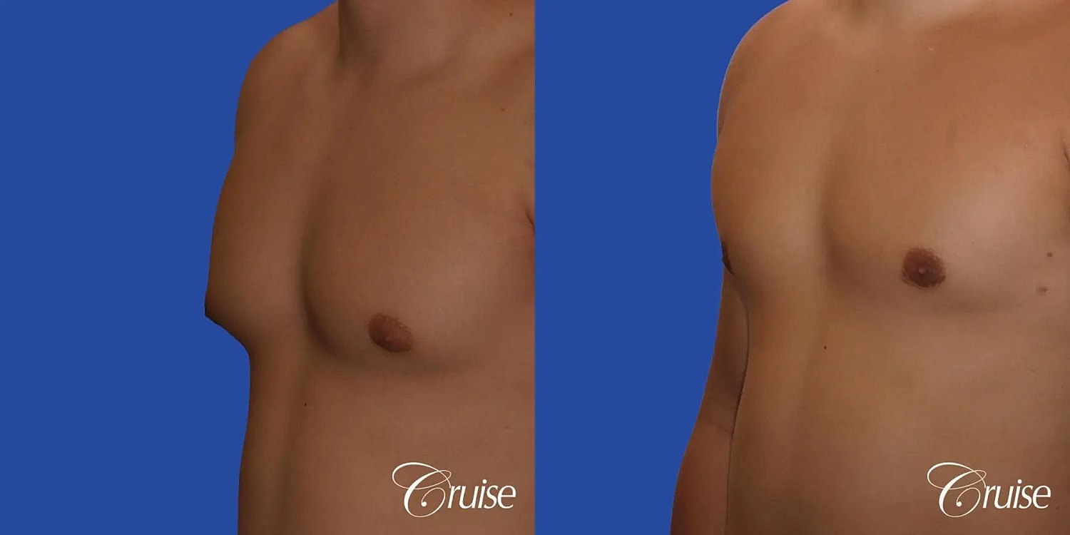 Gynecomastia Surgery Before & After