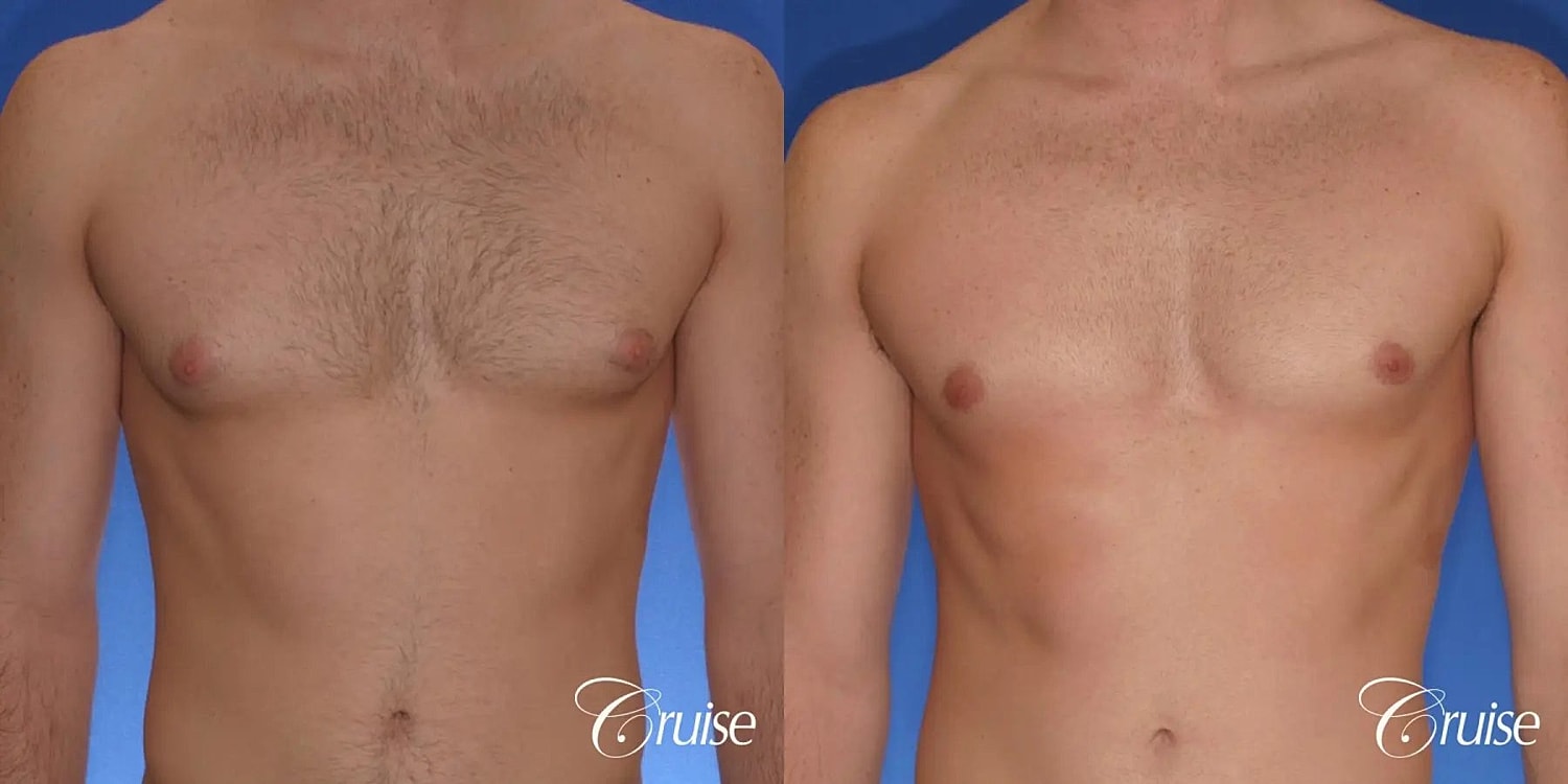 Gynecomastia Surgery Before & After