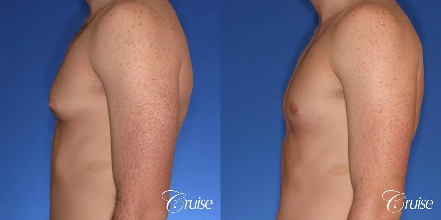 Gynecomastia Surgery Before & After