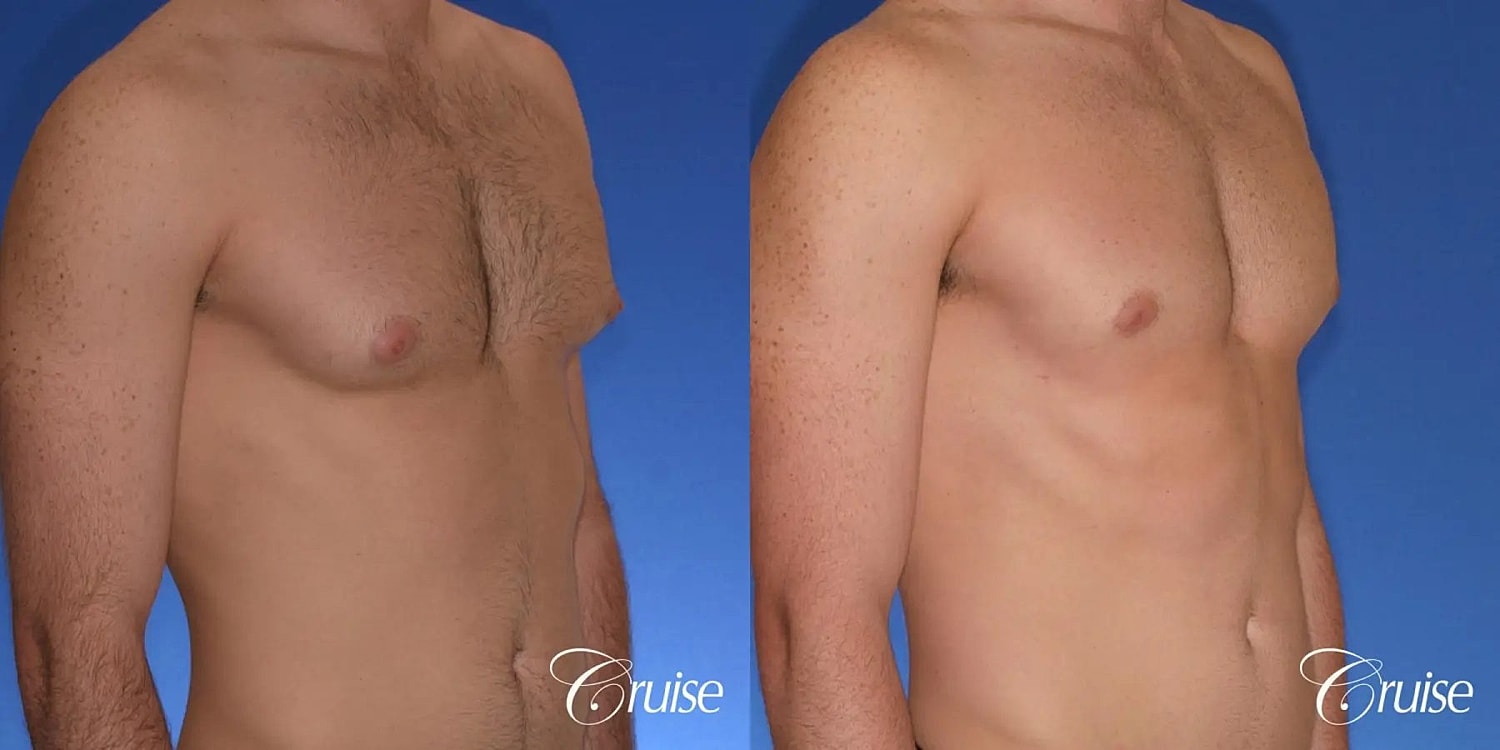 Gynecomastia Surgery Before & After