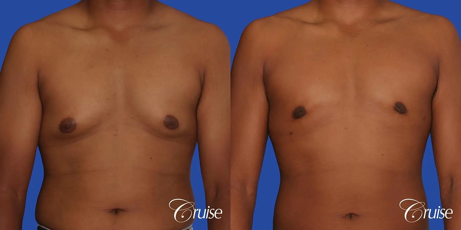 Gynecomastia Surgery Before & After