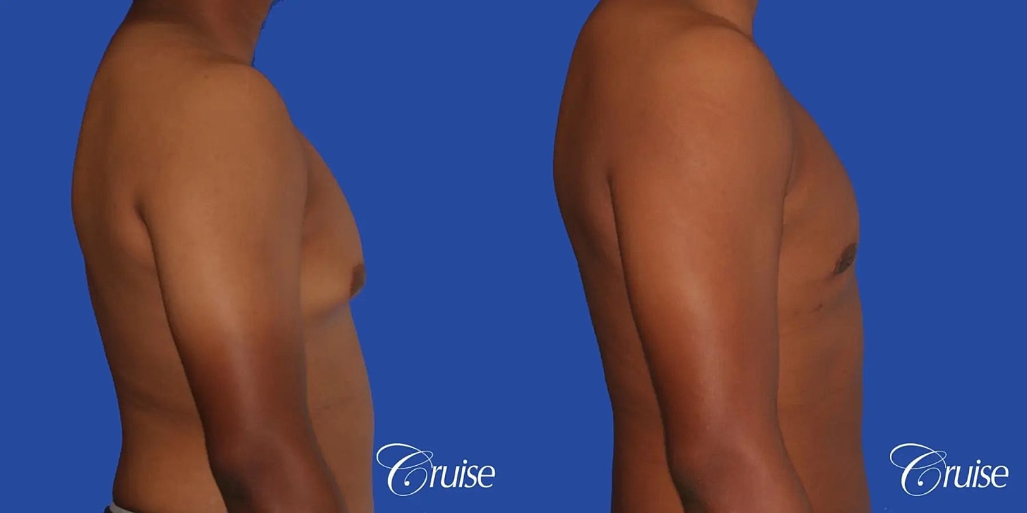 Gynecomastia Surgery Before & After