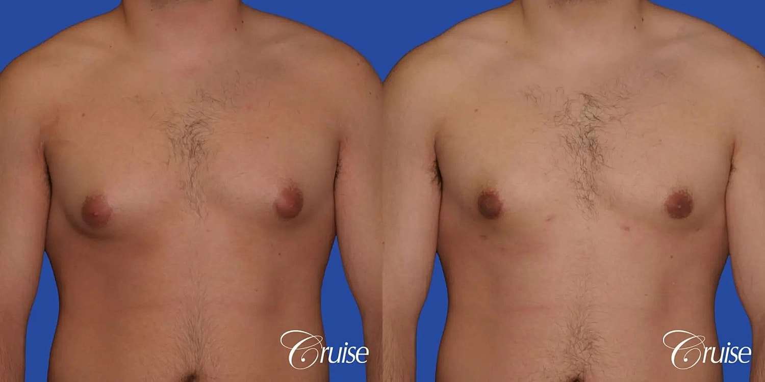 Gynecomastia Surgery Before & After