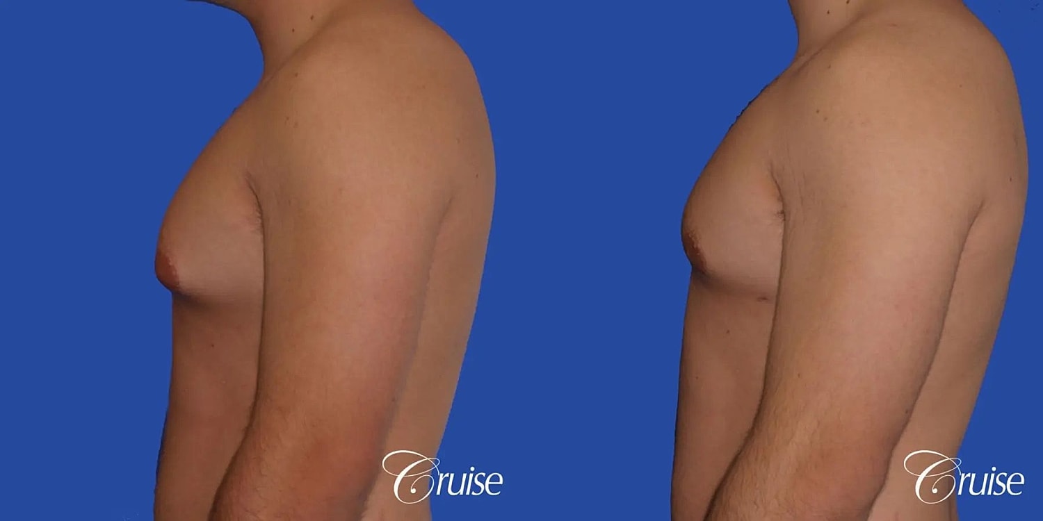 Gynecomastia Surgery Before & After