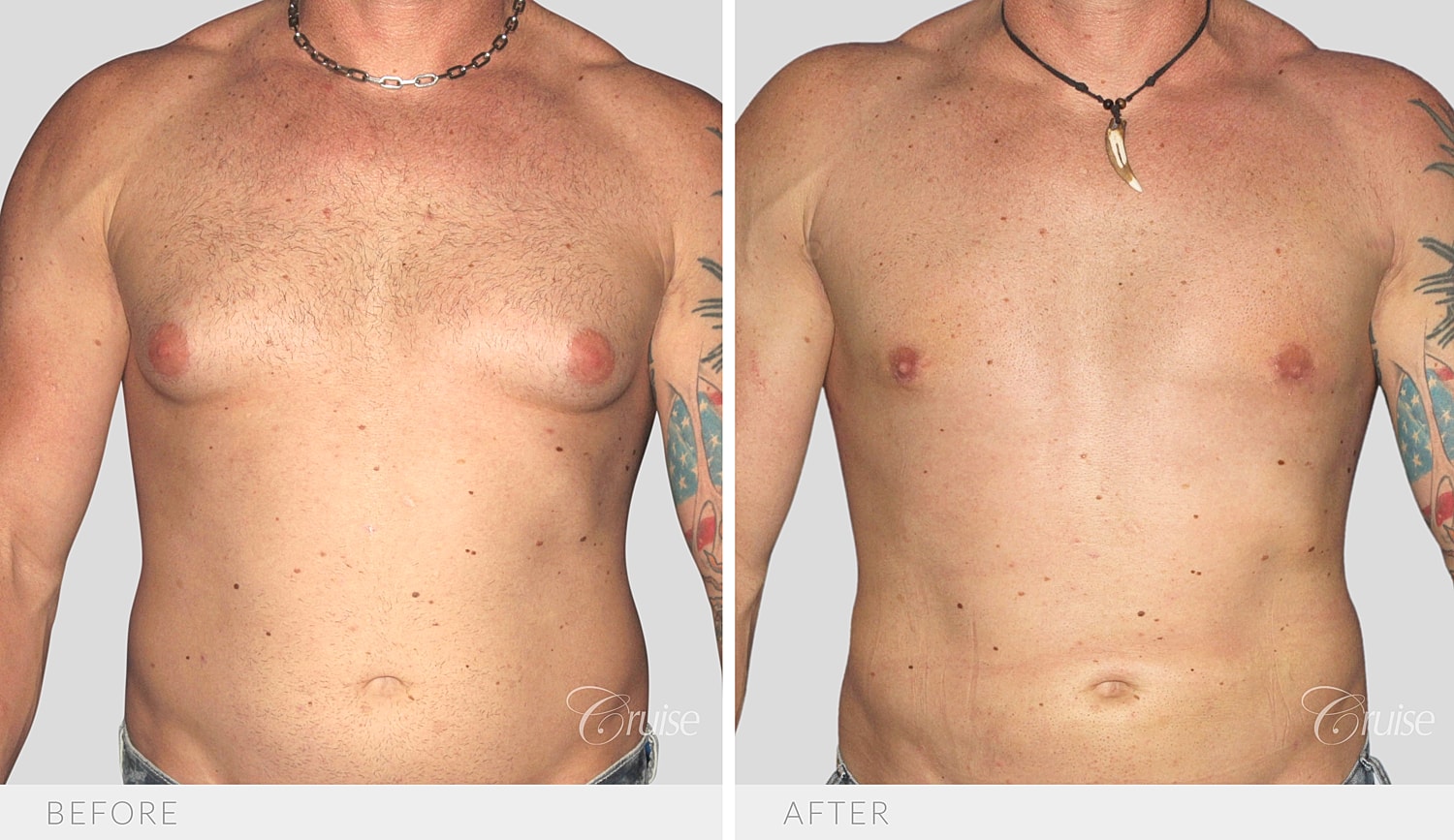 Front view of the chest before and after Type 3 gynecomastia surgery