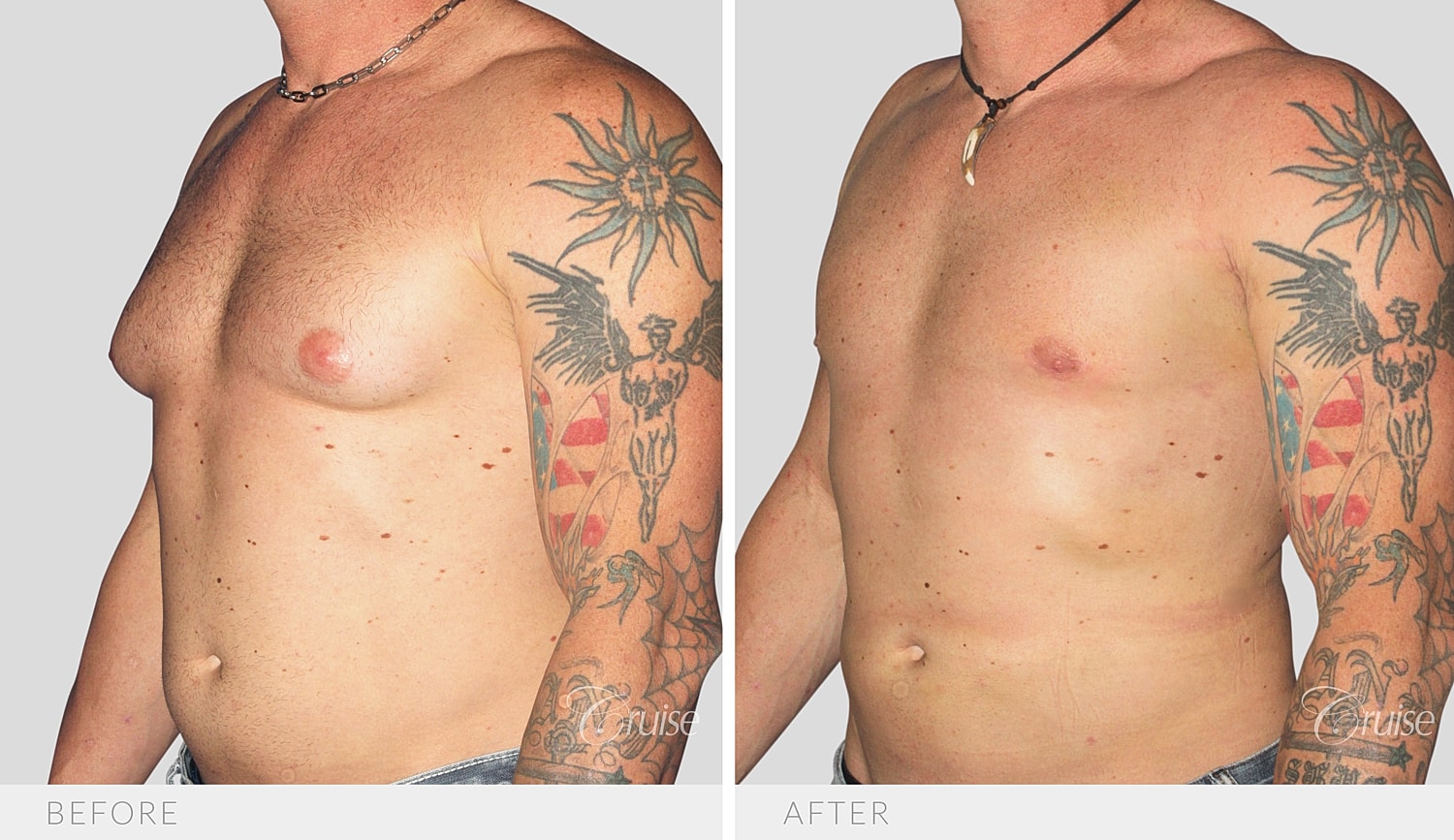 Angled view of the chest contour after gland removal and liposuction