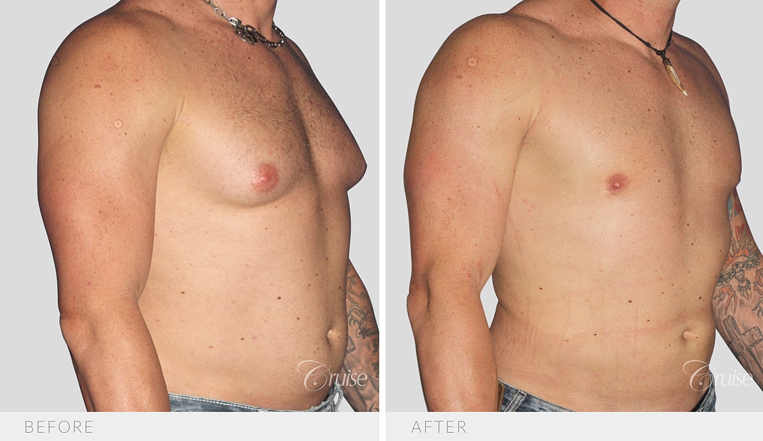Opposite angled view of the chest and torso after surgery